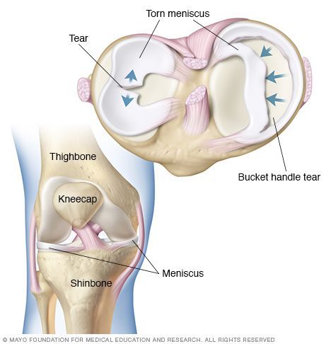 ruptura o lesion de menisco