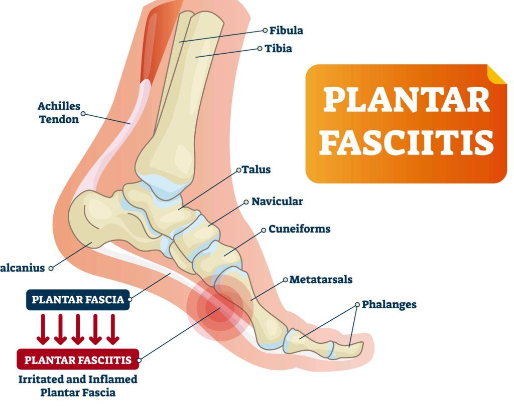 fascitis plantar