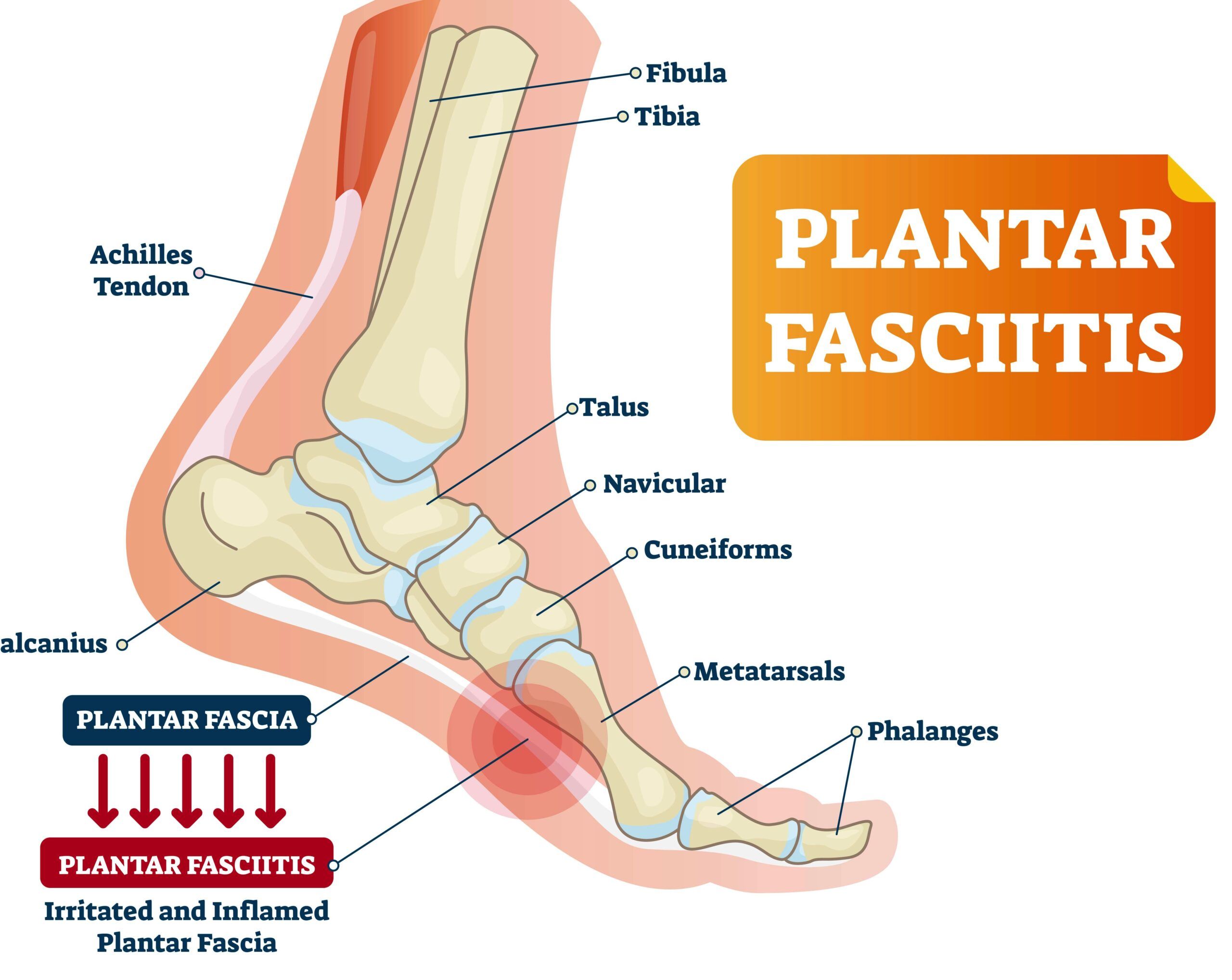 fascitis plantar
