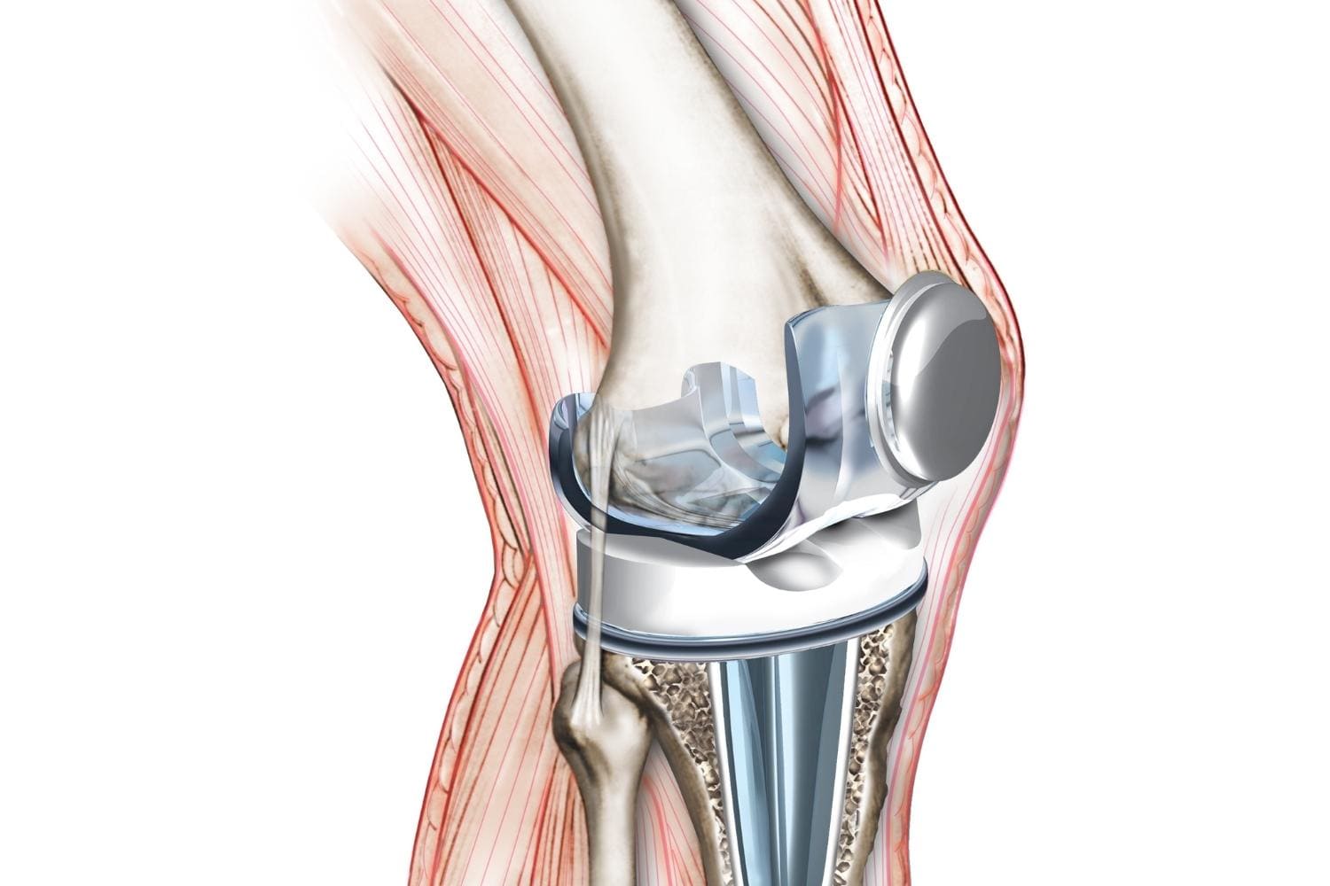 Protesis de rodilla En monterrey Dr Arturo Moran