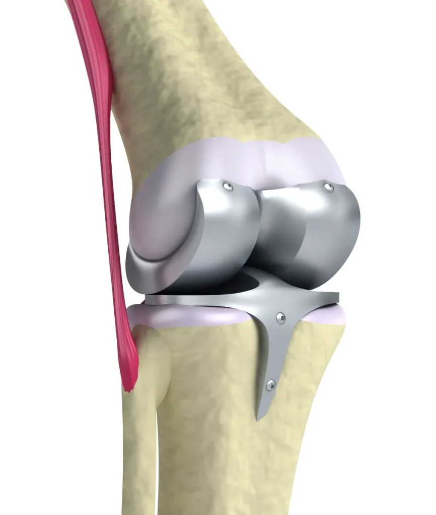 Protesis total de rodilla 11zon
