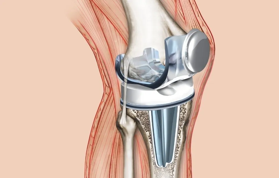 mejor material protesis rodilla 1 11zon